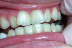 Boding Ρητίνης Πριν