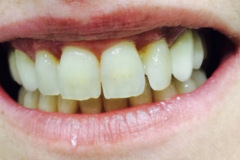 Boding Ρητίνης Πριν