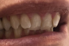 Bonding-ρητίνης-άνω-γνάθου-χωρις-τροχισμα-δοντιών1a