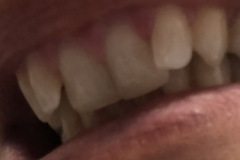 Bonding-ρητίνης-άνω-γνάθου-χωρις-τροχισμα-δοντιών1b