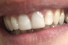 Bonding-ρητίνης-άνω-γνάθου-χωρις-τροχισμα-δοντιών2a