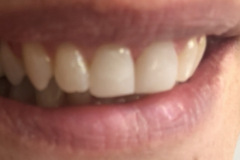 Bonding-ρητίνης-άνω-γνάθου-χωρις-τροχισμα-δοντιών2b