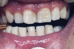 Λεύκανση-και-bonding-ρητίνης1