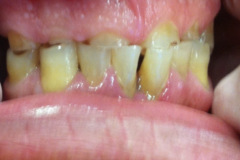 Ουλοπλαστικη-για-επιμήκυνση-μύλος.-Προσθετική-εργασία-μεταλλοπορσελανης1a