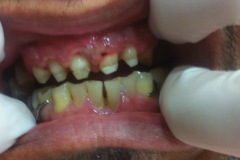 Ουλοπλαστικη-για-επιμήκυνση-μύλος.-Προσθετική-εργασία-μεταλλοπορσελανης1b