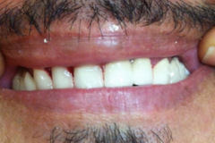 Ουλοπλαστικη-για-επιμήκυνση-μύλος.-Προσθετική-εργασία-μεταλλοπορσελανης2