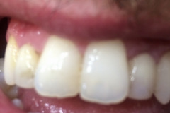 Ουλοπλαστικη-στους-δυο-πλάγιους-και-bonding-ρητίνης-σε-μια-συνέδρια1a