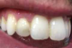 Ουλοπλαστικη-στους-δυο-πλάγιους-και-bonding-ρητίνης-σε-μια-συνέδρια1b