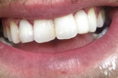 Ουλοπλαστικη-στους-δυο-πλάγιους-και-bonding-ρητίνης-σε-μια-συνέδρια2