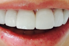 Όψεις-πορσελάνης-άνω-γνάθου2a