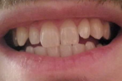 Όψεις-ρητίνης30-1