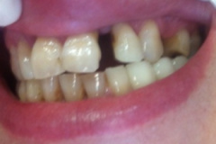 Στεφάνες-και-γέφυρες-ζιρκονίου1