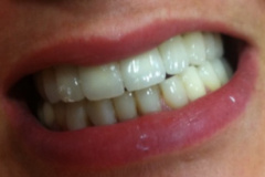 Στεφάνες-και-γέφυρες-ζιρκονίου2