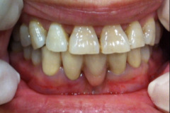 Όψεις-πορσελάνης-άνω-γνάθου.-Γέφυρα-ζιρκονίου-καώ-γνάθου1