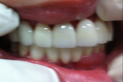 Όψεις-πορσελάνης-άνω-γνάθου.-Γέφυρα-ζιρκονίου-καώ-γνάθου2a