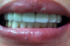 Όψεις-πορσελάνης-άνω-γνάθου.-Γέφυρα-ζιρκονίου-καώ-γνάθου2b