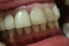 Όψεις-πορσελάνης-άνω-γνάθου10-1