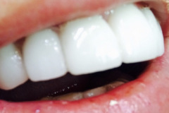 Όψεις-πορσελάνης-άνω-γνάθου2b