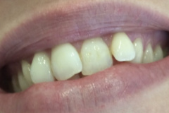 Όψεις-ρητίνης1