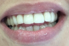 Όψεις-ρητίνης2